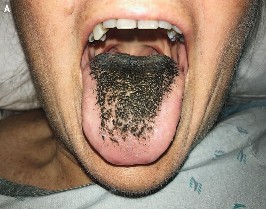 Why This Woman's Black, Hairy Tongue Actually Isn't as Scary as It Looks