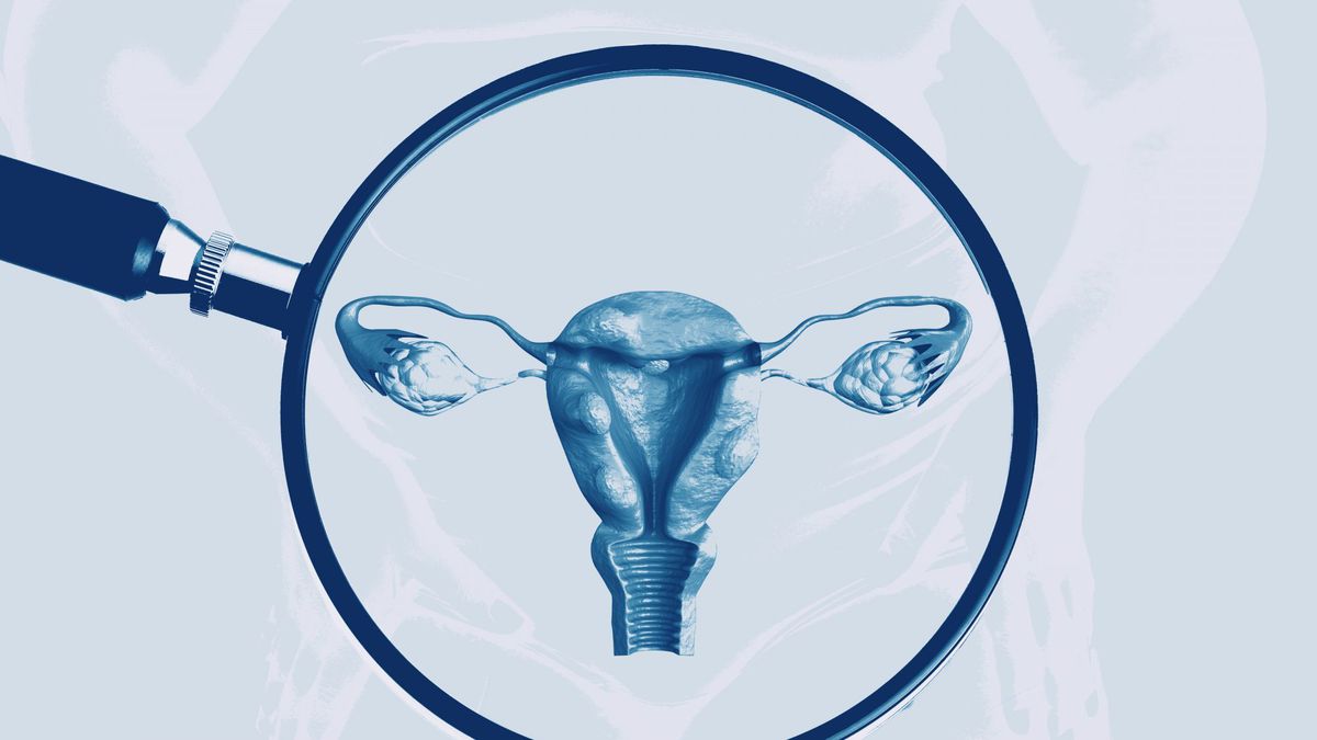 10 Uterine Fibroid Treatments to Consider, Including Fertility-Sparing Options