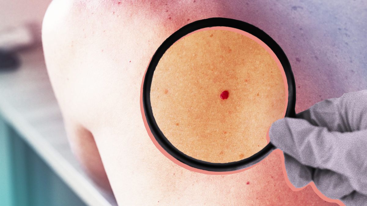 Why You Might Have Red, Raised Bumps on Your Skin—And How to Get Rid of Them