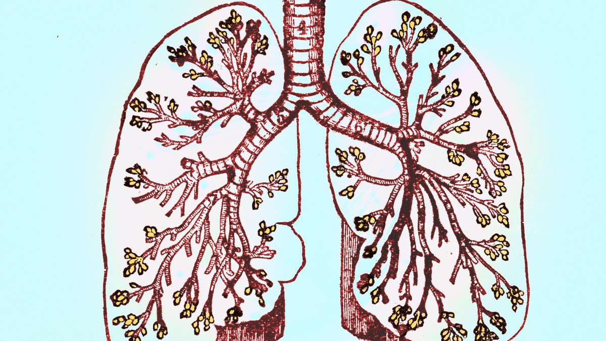 Double Pneumonia Is an Infection in Both Lungs—Here's What to Know, According to Doctors