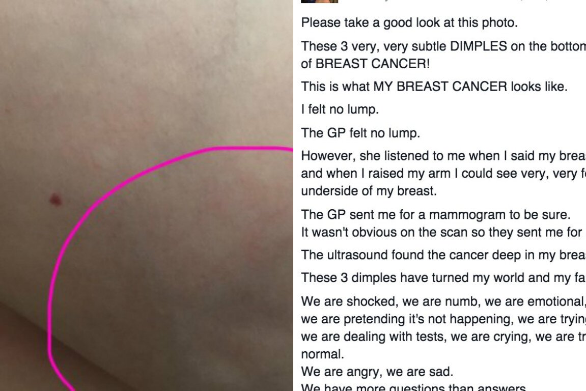 This Woman Posted A Photo Of Her Breast Cancer As A Warning For Everyone Hellogiggles