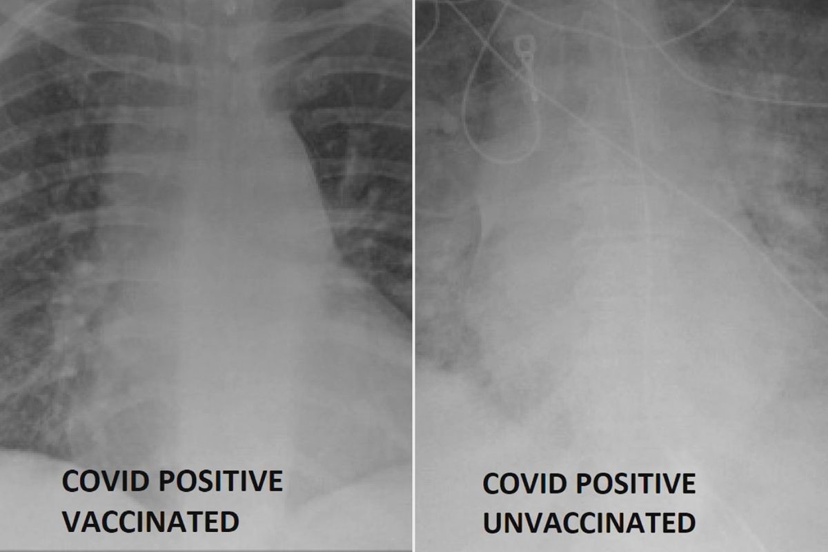 COVID-19肺部x光片显示了接种疫苗的不同
