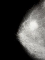 breast-cancer-tumor-150.jpg