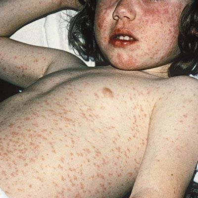 child-girl-measles
