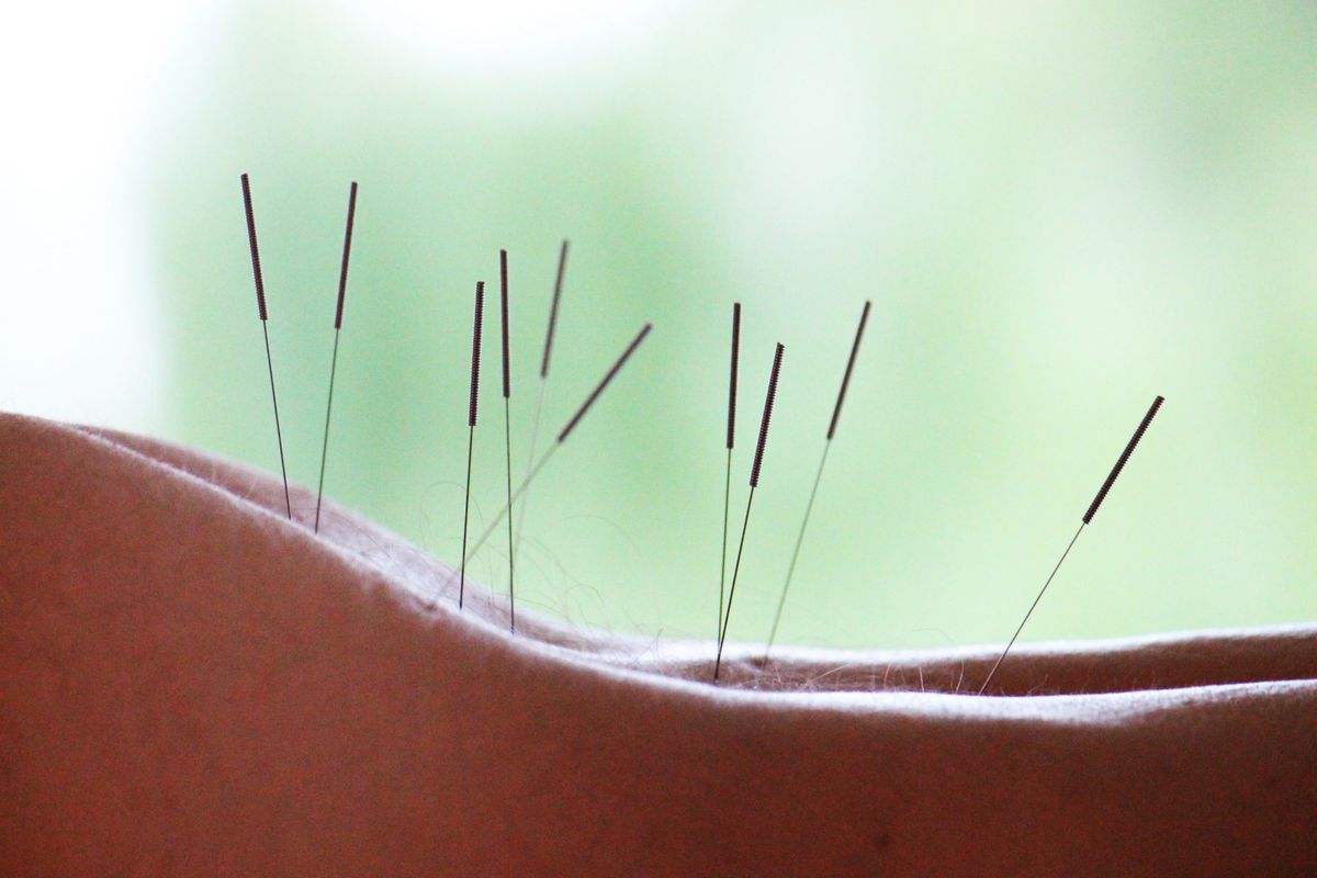 acupuncture-back-needles