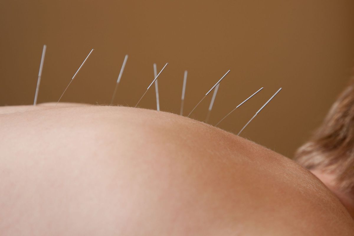 acupuncture-allergy