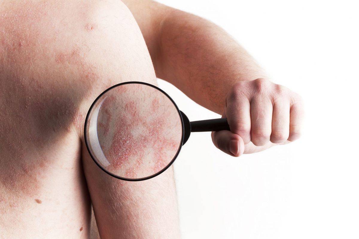 6-things-that-can-make-psoriasis-better-video