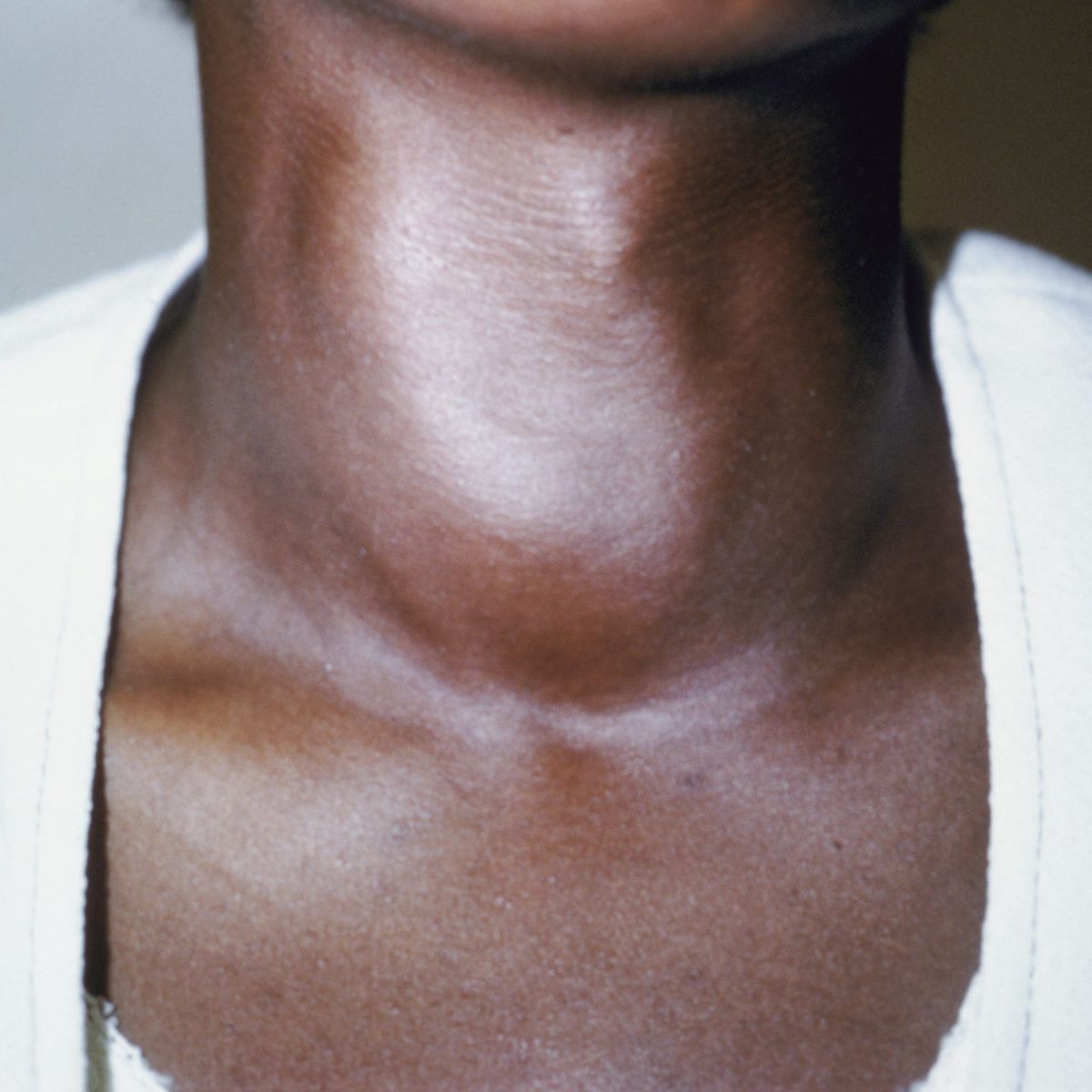 Iodine deficiency can cause a goiter