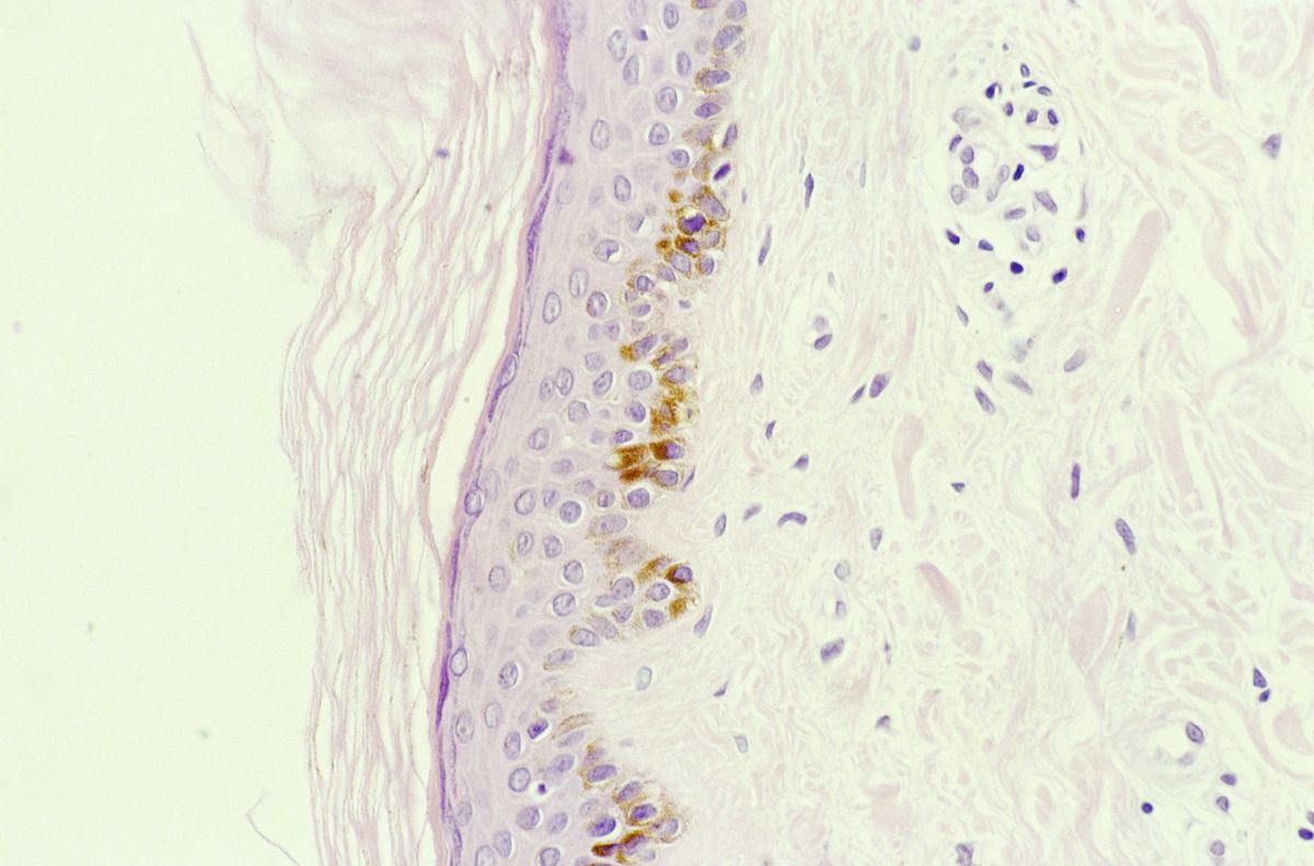 11-Ichthyosis-scaly-skin