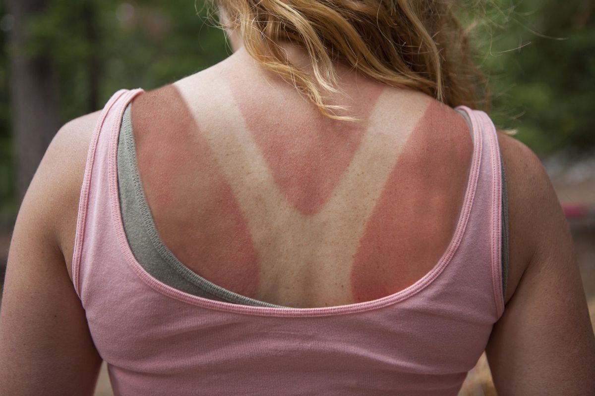12-sunburn-scaly-skin