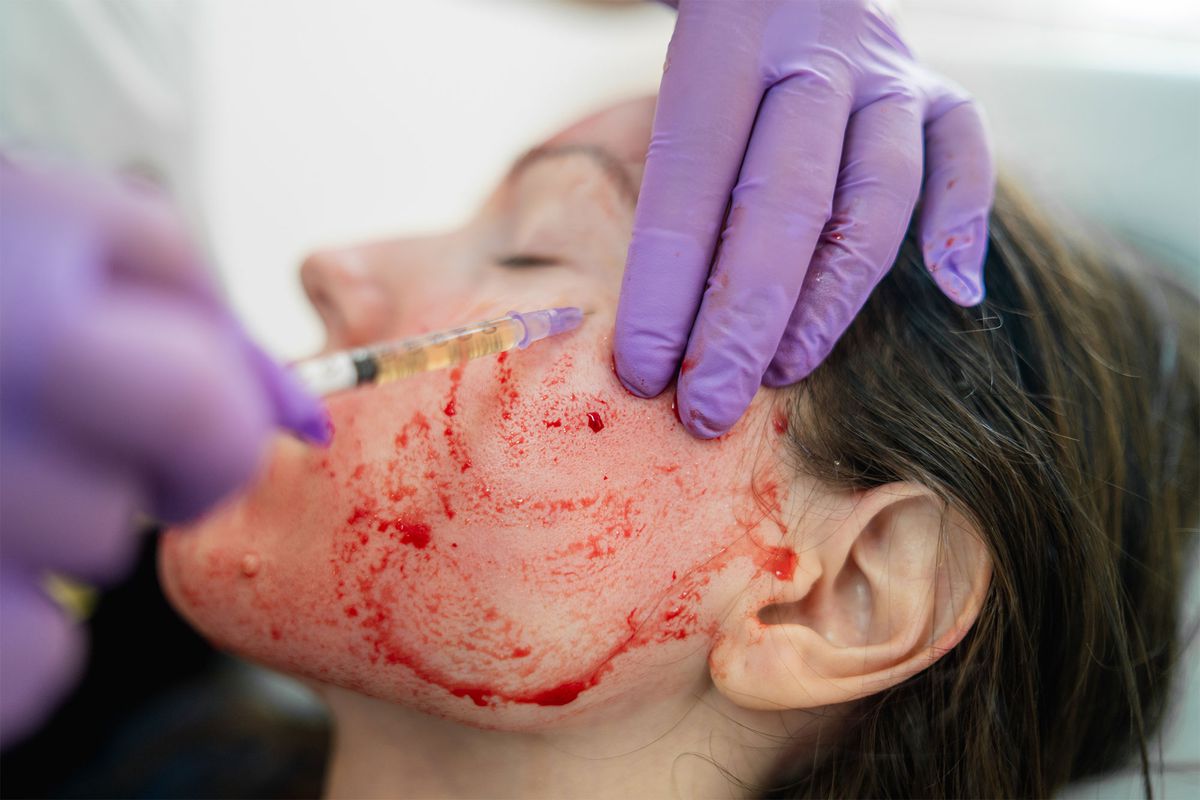 Clients Who Underwent Vampire Facials at New Mexico Spa Urged to Get Tested for HIV