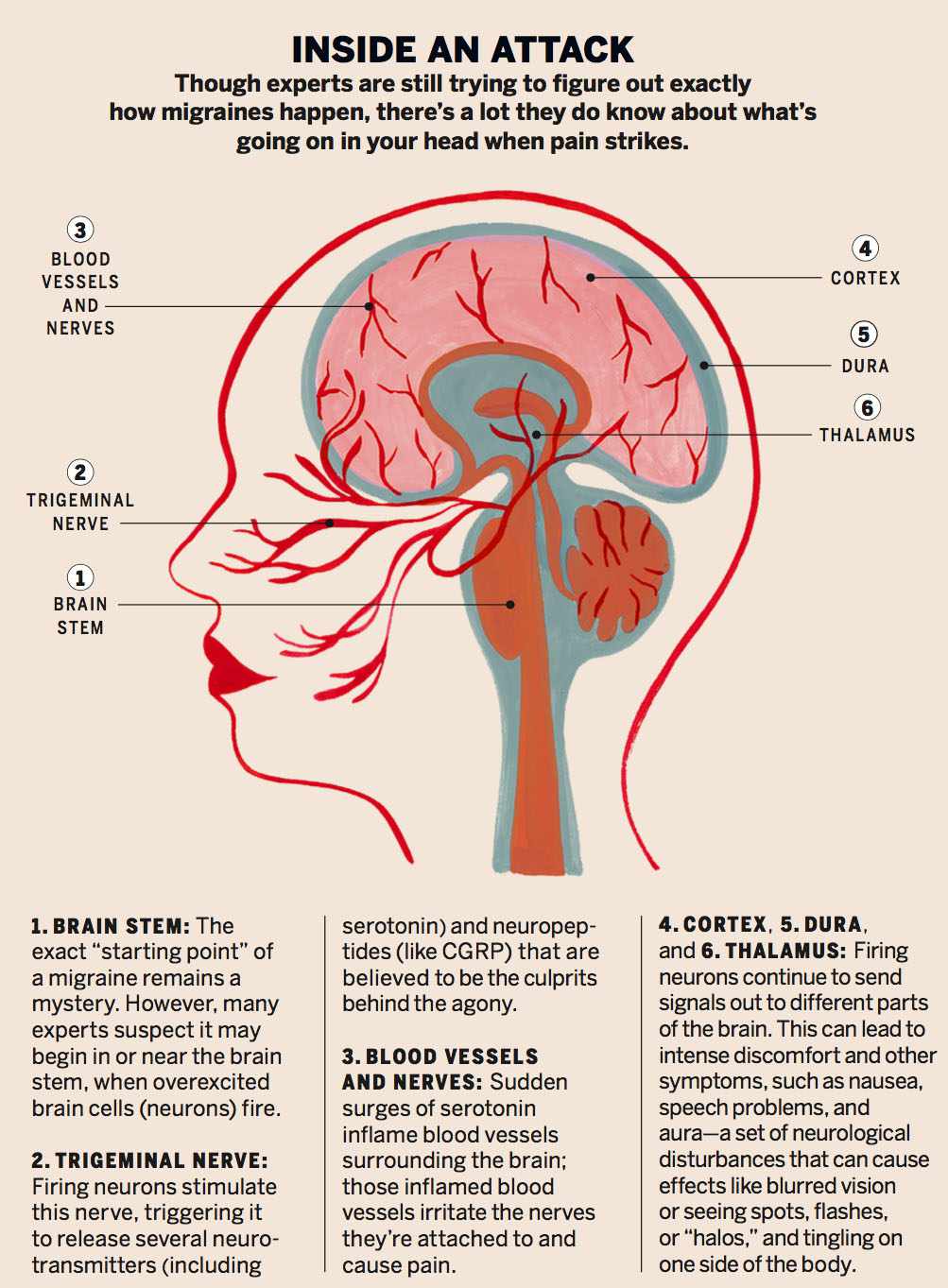 migraine-infographic