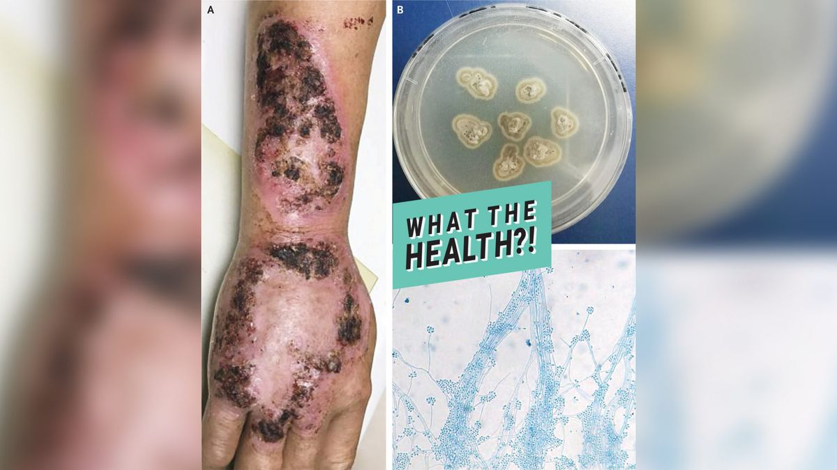 what-the-health infection virus condition skin health wellbeing