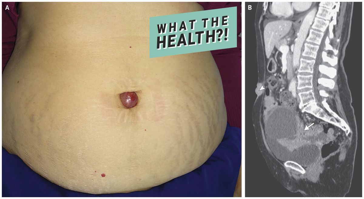 wth health condition umbilical belly button