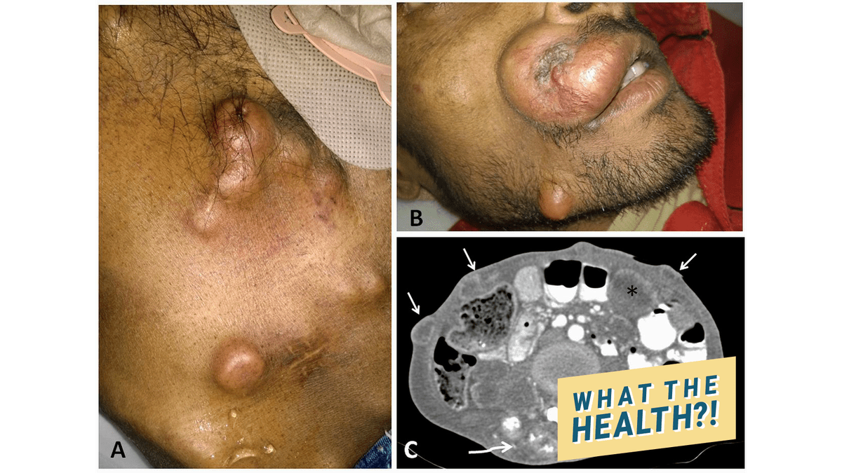 wth Cutaneous metastasis in adenocarcinoma rectum