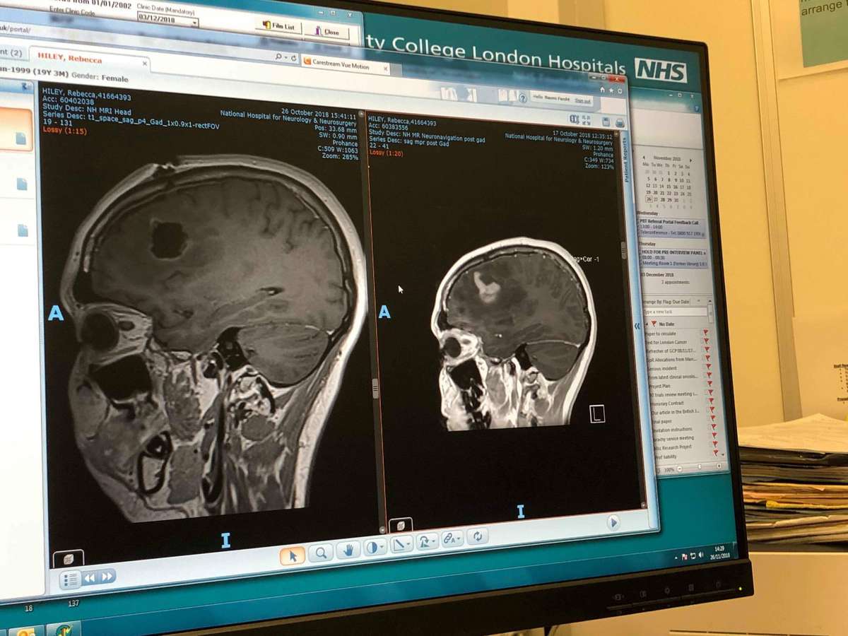 This Woman's Brain Tumor Symptoms Were Dismissed as Headaches