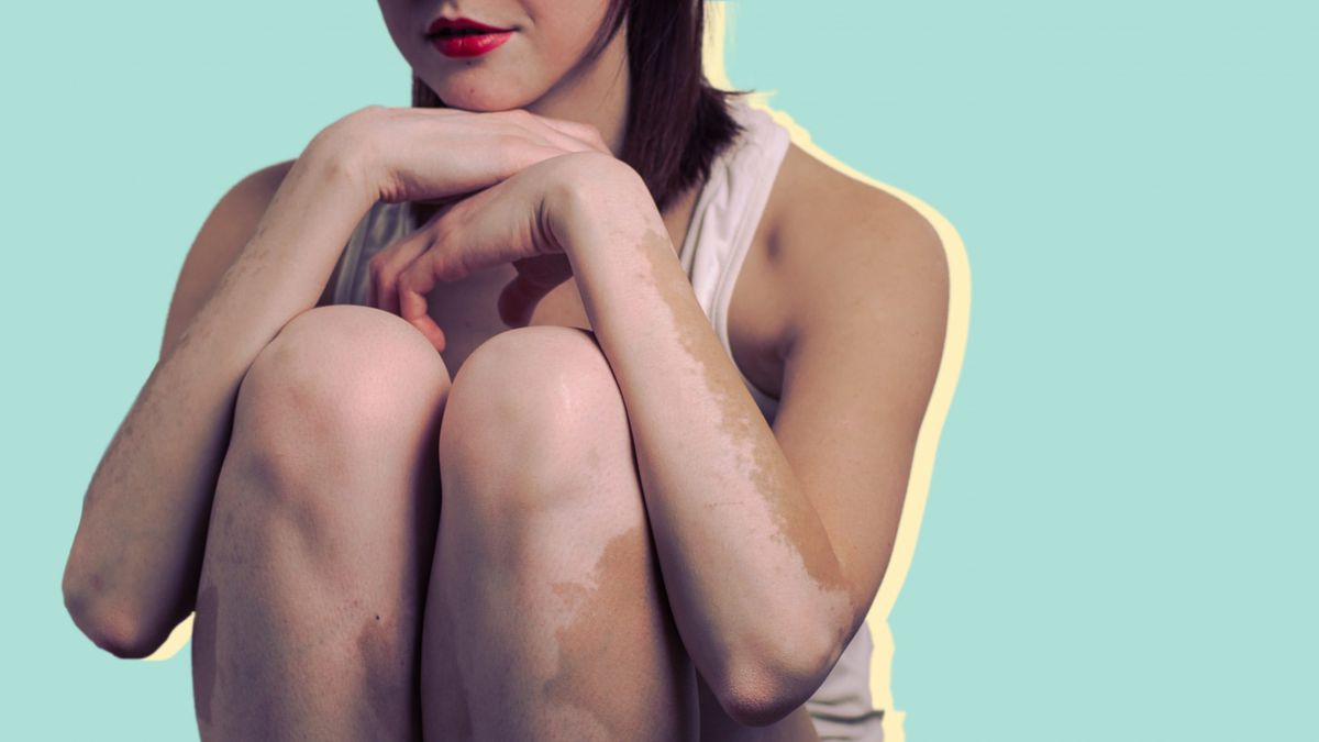 vitiligo treatment diagnosis woman health skin condition