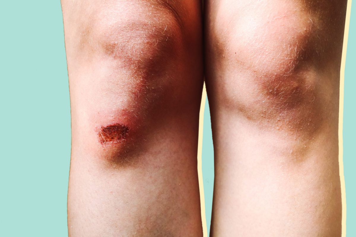 cellulitis woman health scraped-knee knee injury infection bacteria
