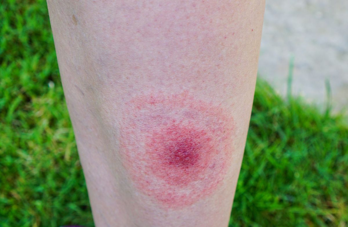 tick-bite skin bite bug outdoors rash hive lyme-disease lyme