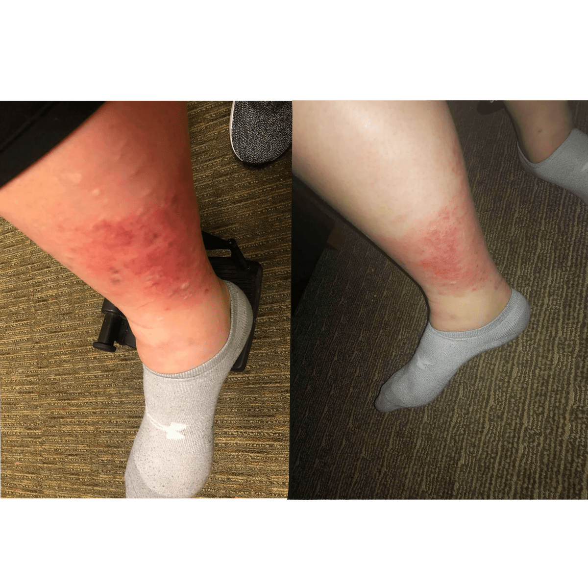 hot-tub-infection hot-tub-rash woman leg health necrosis cellulitis infection