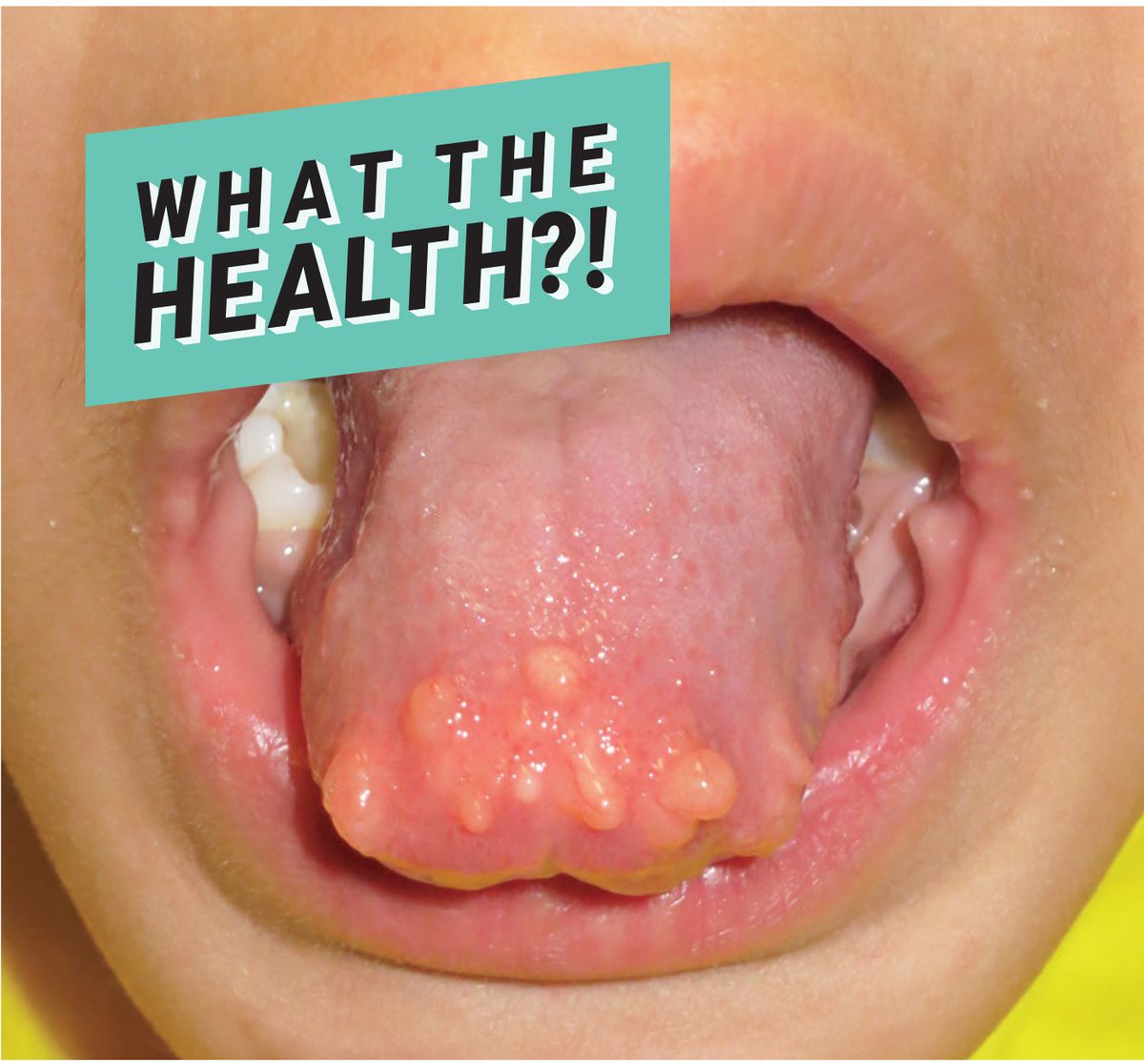 health tongue infection virus condition