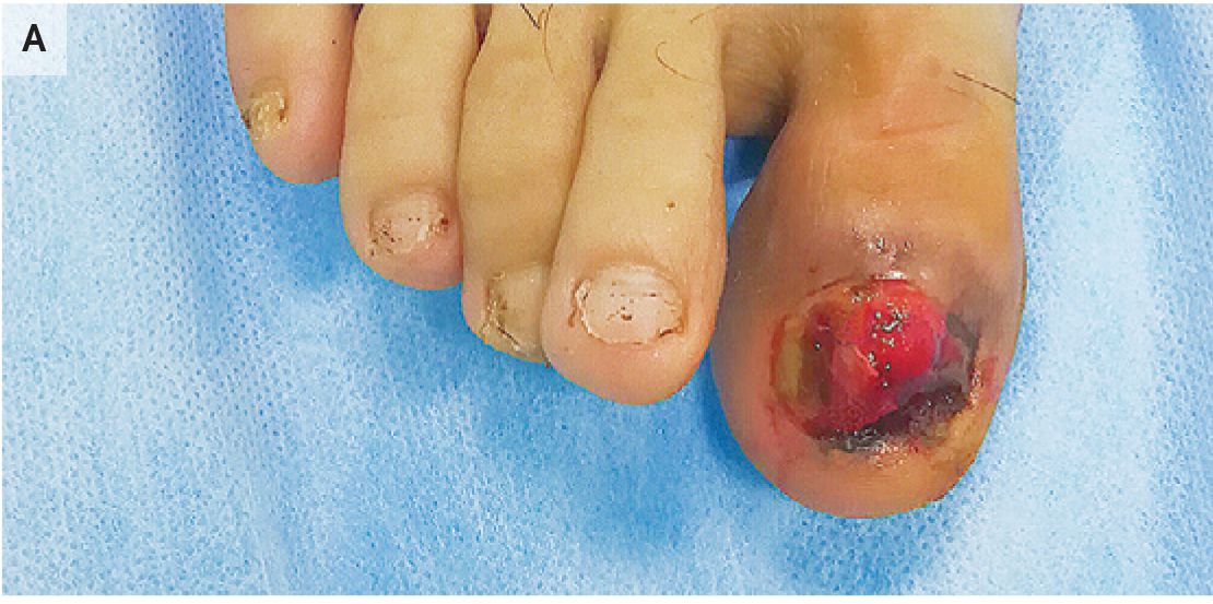bleeding-toe-embed-1