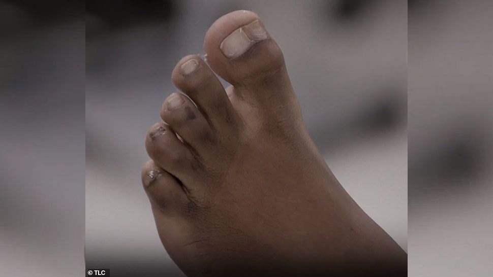 This Woman S Double Big Toe Yes A Toe Within A Toe Was So Painful She Needed Corrective Surgery Health Com