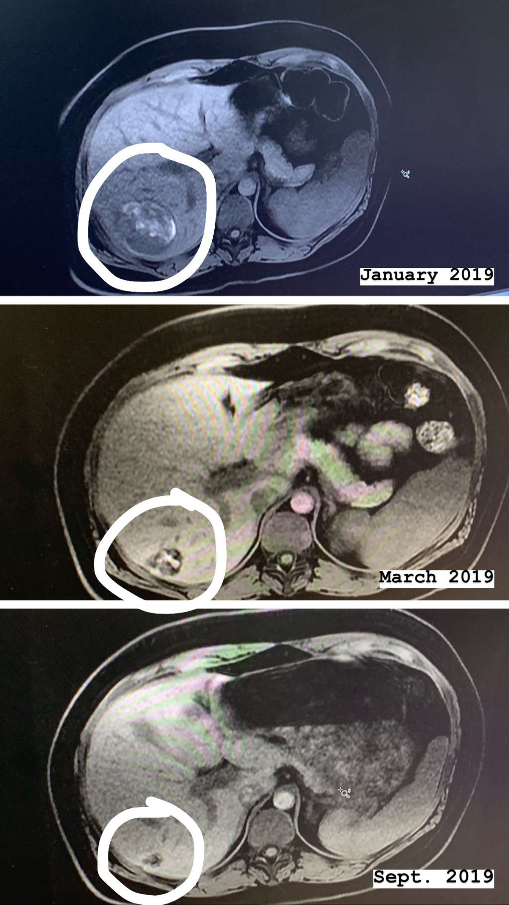 MRI liver tumor