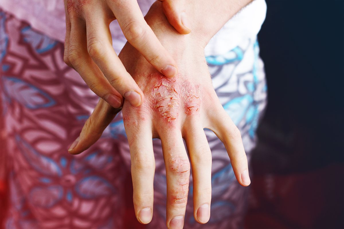 Closeup men itching and scratching by hand. Psoriasis or eczema on the hand. Atopic allergy skin with red spots. psoriasis-quarantine , covid-19 , skin , psoriasis