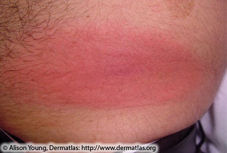 lyme-disease-rash