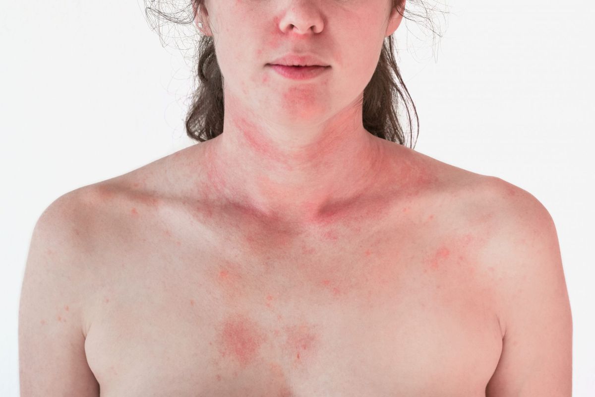 Allergic skin reaction on the female neck and face - red rash
