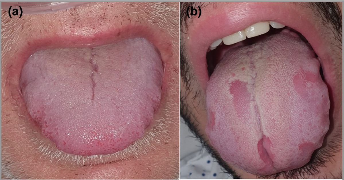 Blister small tongue clear under Types of