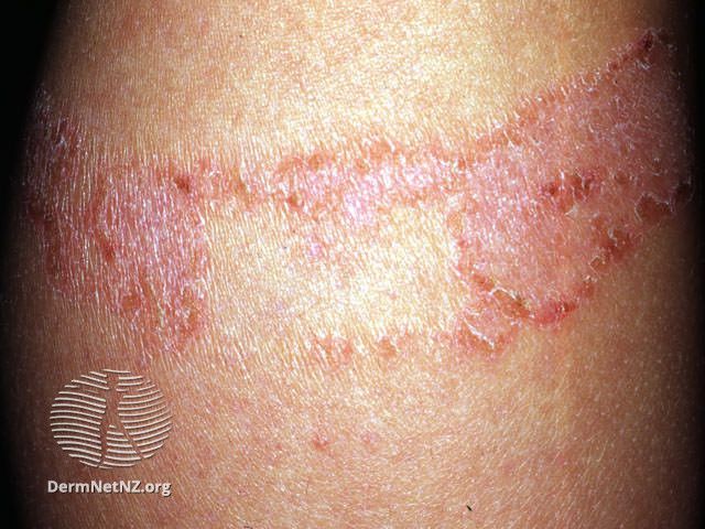 Allergy-Rash-Explainer-Contact-Dermatitis