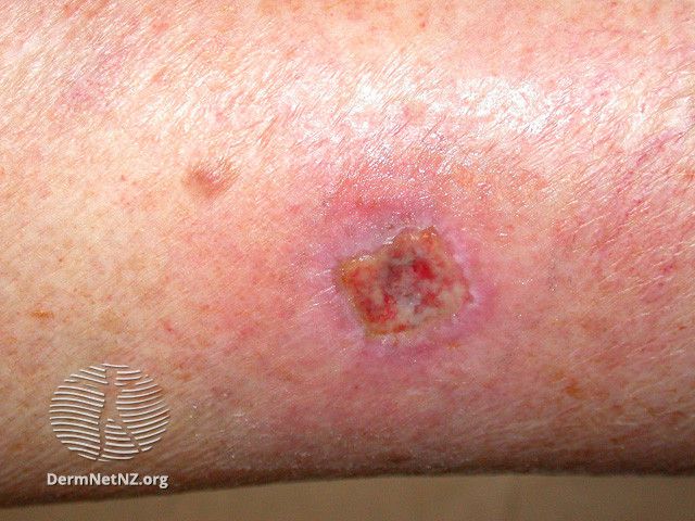Wound infection