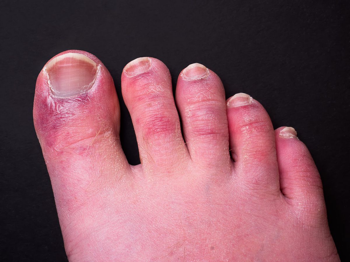 COVID-Toe-Embed-GettyImages_ 1250715074