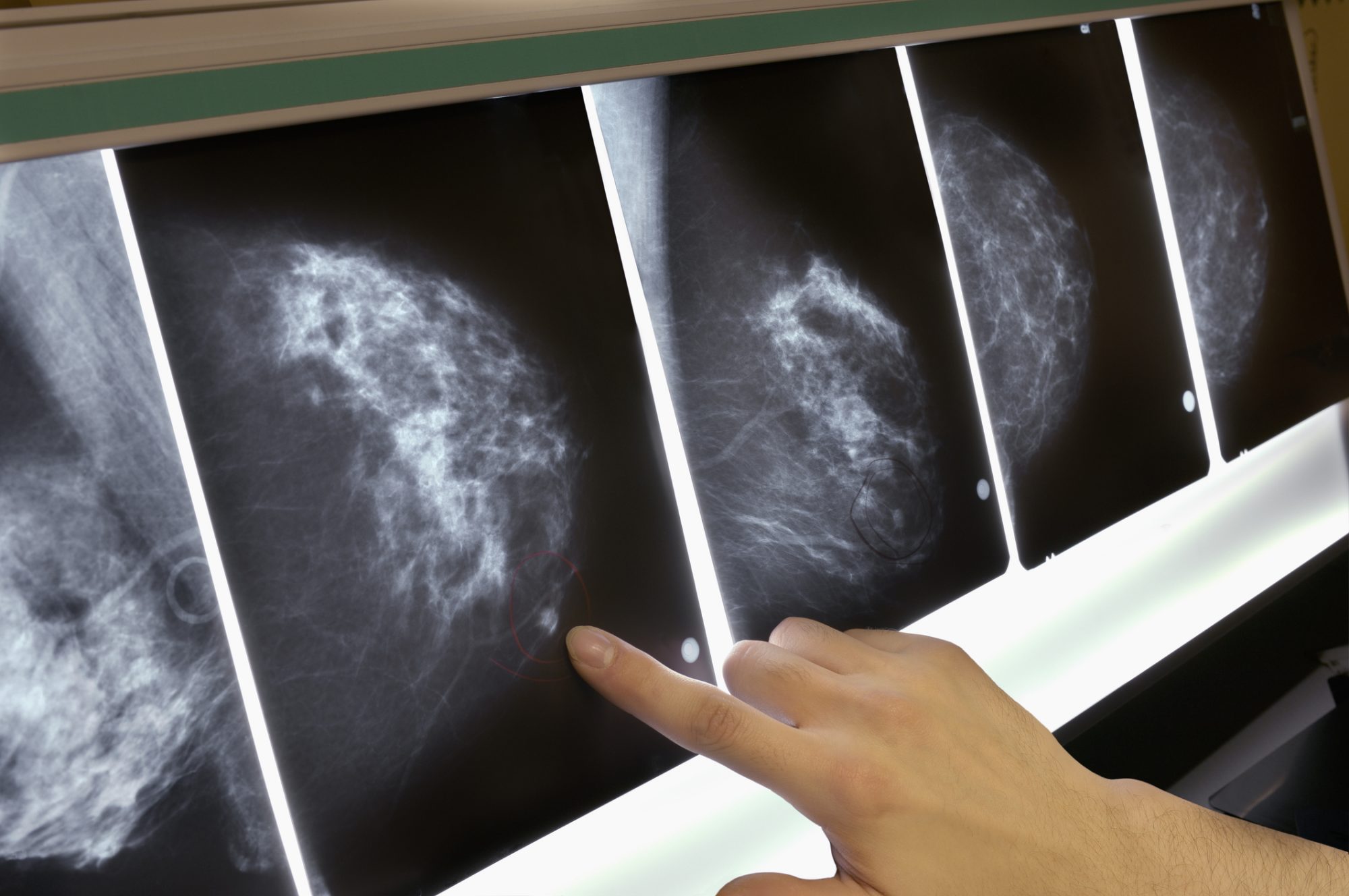 breast cancer myths