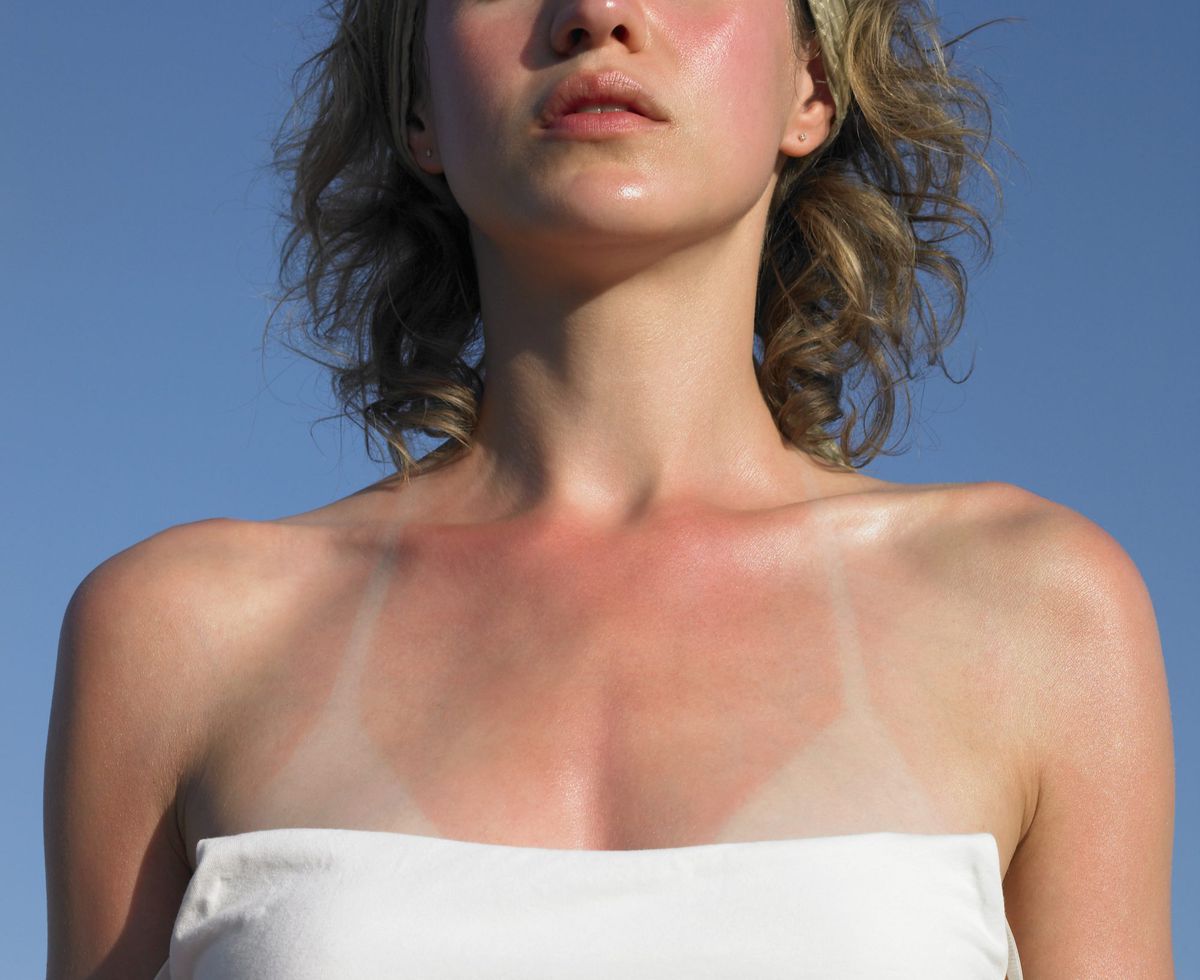 You Got a Sunburn and Your Skin Is Peeling — Now What?