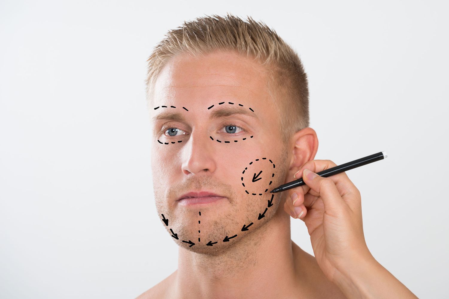 Man With Correction Mark For Plastic Surgery