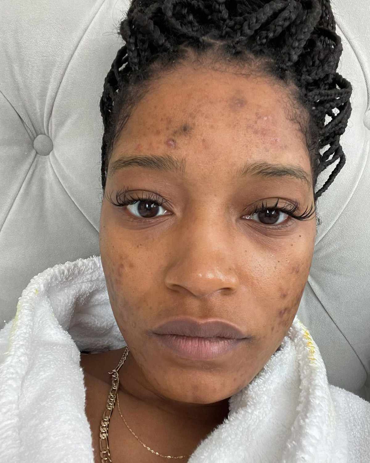 Keke Palmer Reveals She Has Polycystic Ovary Syndrome in Posts Showing Her Acne
