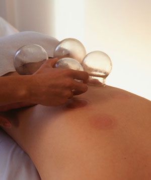 Woman lying face down having cupping acupuncture