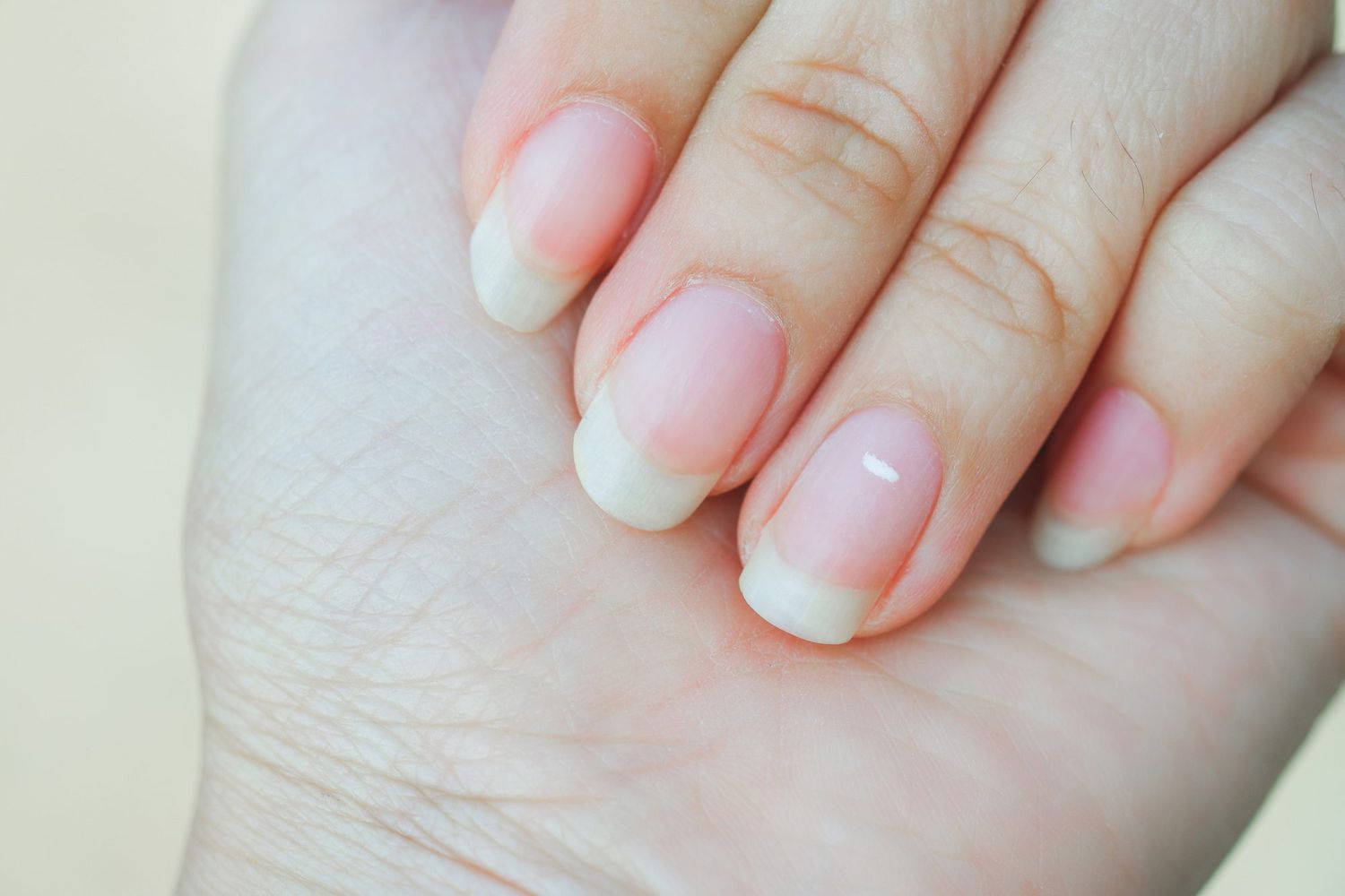 White spots or Leukonychia punctata on a woman's fingernails