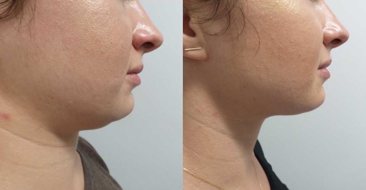 two photos showing results of kybella injectable treatment before and after, after two treatments