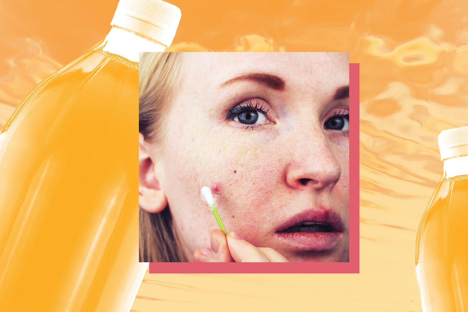 Can Using Apple Cider Vinegar for Acne Actually Prevent Zits? - Young woman with acne. Applying apple cider vinegar to the pimple. Beauty, skin care lifestyle concept.