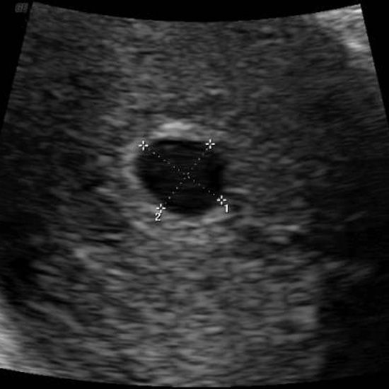 At weeks sonogram 2 Pregnancy Ultrasound
