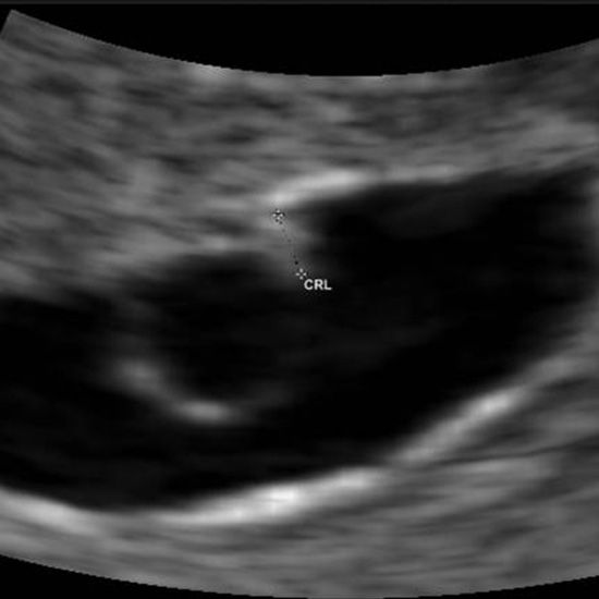 5 Week Ultrasound
