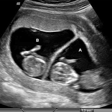 Ultrasound 12 weeks twin 12 Weeks