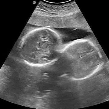 twins ultrasound week 20