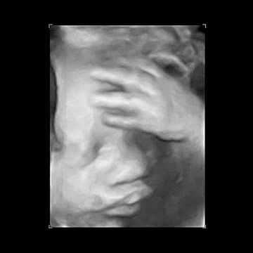 More About Prenatal Ultrasounds