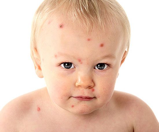 baby with Chicken Pox