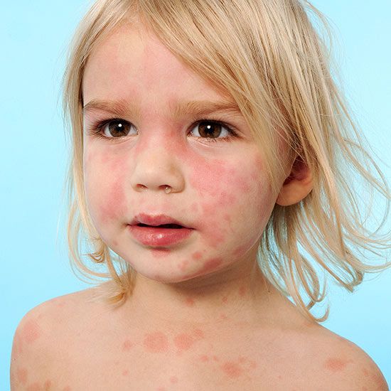 child with hives rash